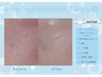 ユアーズ ビューティー(YOURS beauty)/スキンジェクション