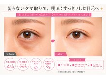 オリエンタルローザ 表参道(Oriental Rosa)/目の下の凸凹[切らないクマ取り]