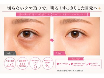 オリエンタルローザ 表参道(Oriental Rosa)/目の下の凸凹[切らないクマ取り]