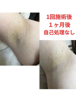 ヒカリ(Hikari)/1回で驚きの効果!!