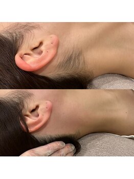 ニクス 札幌(NIX)/うなじワックス