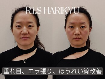 リス(R.i.S)/小顔矯正Before&After