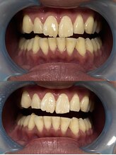 サロン ド ルナ(Salon de Luna)/セルフホワイトニング1回の効果