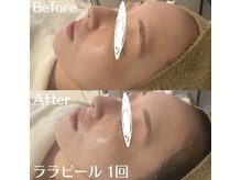 ホワイトアクア 中目黒店(WHITE AQUA)/ララピール/毛穴/中目黒