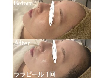 ホワイトアクア 中目黒店(WHITE AQUA)/ララピール/毛穴/中目黒