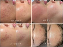 インテリウス(INteRius.)の雰囲気（ニキビケア/肌トラブル跡ケア/凸凹肌ケア/毛穴ケア/肌質改善）