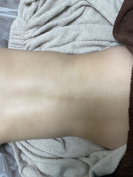 カルム(calm.)/背中シュガーリング後