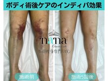 ナナ 銀座(Nana)/太もも術後ケアインディバ数回