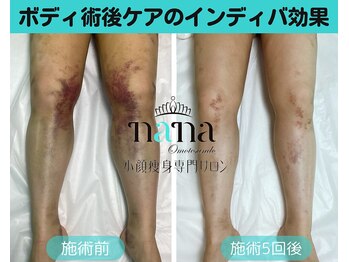 ナナ 銀座(Nana)/太もも術後ケアインディバ数回