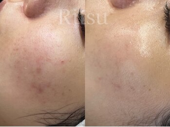 リツ(Ritsu)/熱ダメージによる肌ダメージ