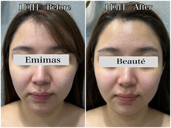 エミマス ボーテ(Emimas Beaute’)/２０代後半　小顔矯正＆毛穴洗浄