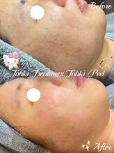 ラティーナ(Lattina)/ニキビ　ハーブピーリング