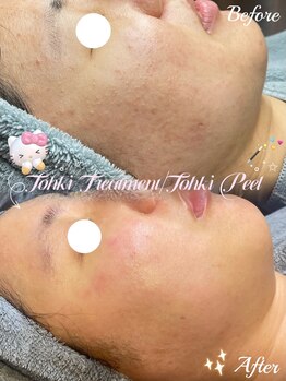 ラティーナ(Lattina)/ニキビ　ハーブピーリング