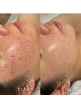 シーラックス(Sealax)/ニキビケア