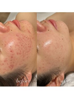 シーラックス(Sealax)/ニキビケア