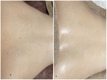 ルノン(Lunon)/ハーブ×美白導入