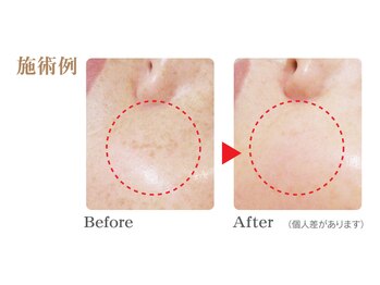 サロン ド ボーテ プルーラ(Salon de beaute PLURA)/目尻や頬のシミ改善!