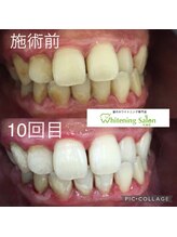 ホワイトニングサロン 札幌店/ 【ホワイトニング施術例】#札幌