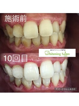 ホワイトニングサロン 札幌店/ 【ホワイトニング施術例】#札幌