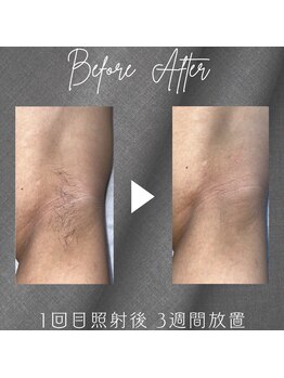 イーシア(e.cia)/1回目からしっかり効果実感！！