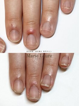 マリーロール 梅田店(Marie Laure)/自爪育成/深爪矯正/ネイルケア