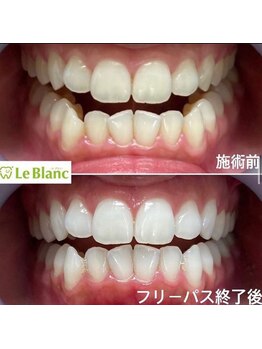 ルブラン 奈良店(Le Blanc)/映える白い歯に!