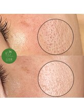 エマ(emma)/お肌を活性化させて、引き締める