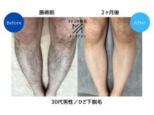 メンズアメリ/高知/メンズ脱毛/ヒゲ/全身/VIO