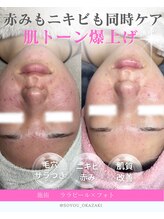 ソユ(SOYOU)/施術* &nbsp;&nbsp;&nbsp;&nbsp;&nbsp;ララピール×フォト