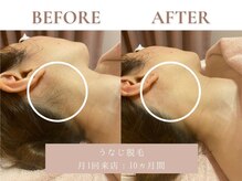 サエラ(SAERA)/うなじ脱毛【10回】