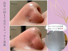 ナチュールファースト(naturel first)の雰囲気（日本初！トルネード型吸引で毛穴をごっそり洗浄！）