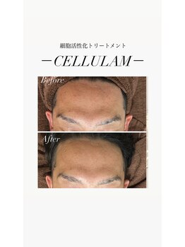 リバイセリー(Revicelly)/比較写真