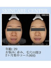 アンジェラックス スキンケアセンター 渋谷/毛穴の開き・黒ずみ改善