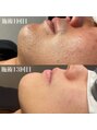 エクリア(ECLIA) 【メンズ脱毛顔全体】13回受けて頂いた方のBefore→ After