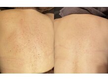 ジュエリーボディー(Jewelry body)/身体のハーブピーリング