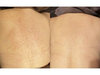 ジュエリーボディー(Jewelry body)/身体のハーブピーリング