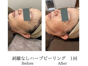 ミーシェ(Meshie)/剥離なしハーブピーリング