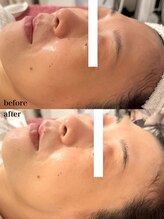 ルミナス(Luminous)/ララピールのbeforeとafter