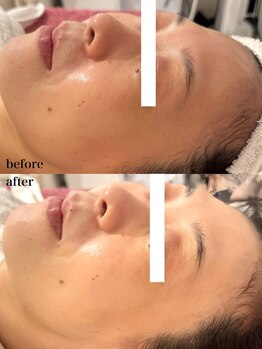 ルミナス(Luminous)/ララピールのbeforeとafter