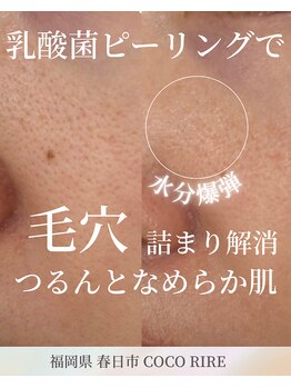 ココリール/毛穴の開き　黒ずみ