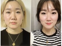 たるみ・ほうれい線、しみケア、小顔も実現/自信を持てるお顔に