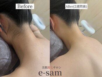 イーサム 高槻摂津富田店(e-sam)/丸ごと全身脱毛