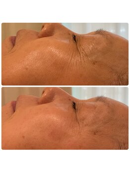 アネランスパ(Anelan Spa.)/光×ヒト幹細胞でシワシミケア