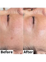 マハロハ 自由が丘(Mahaloha)/【シミケア・くすみ改善施術】