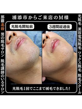 メンズディースタイル 首里店(Men's Dstyle)/那覇メンズ脱毛Before After