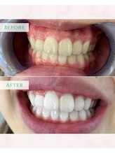 シカホワイトニングトウキョウ 笹塚店(CICA Whitening Tokyo)/ビフォーアフター(20代女性）