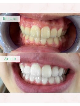 シカホワイトニングトウキョウ 笹塚店(CICA Whitening Tokyo)/ビフォーアフター(20代女性）