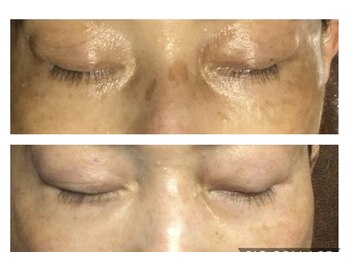 ブリエールラミール/シミケア