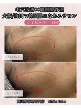 ホワイトラボ 梅田(White labo)/【施術例】ラミピール