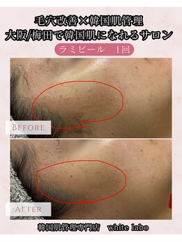 ホワイトラボ 梅田(White labo)/【施術例】ラミピール